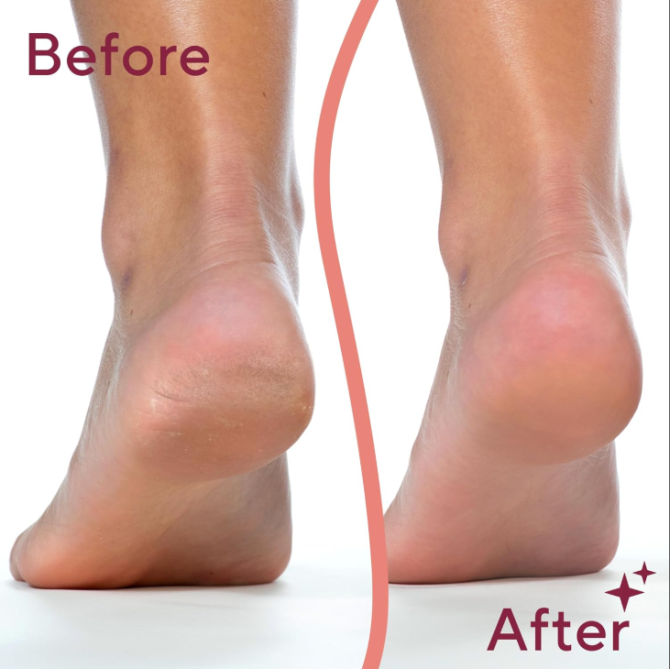 Finishing Touch Flawless Pedi Electronic Tool File and Callus Remover, Pedicure-New Version (Amazon Exclusive) - Image 4