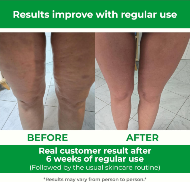 TESMED Cellulite Manual Massager : Made in Italy, Patented with Converging & Diverging Roller Technology. Anti Cellulite Roller for Thighs and Buttocks - Image 7